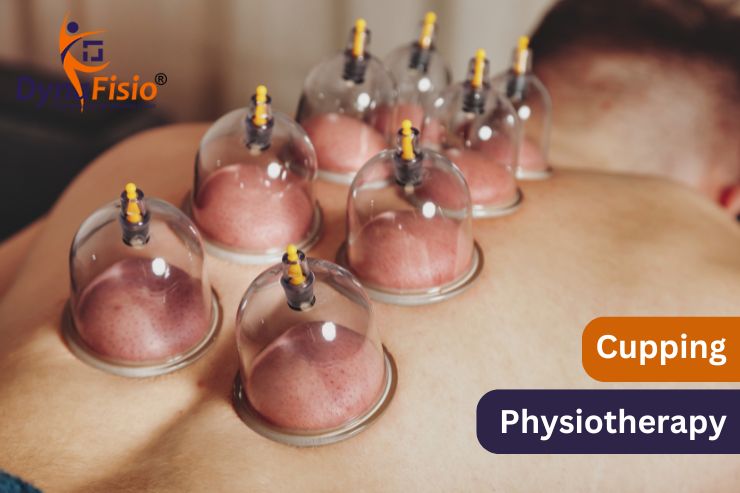 Cupping Therapy: A Natural Approach to Pain Relief and Wellness