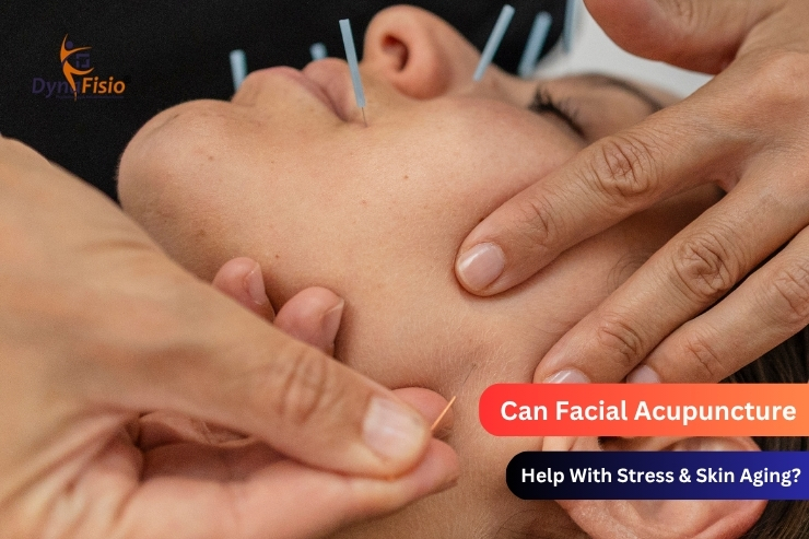 Can Facial Acupuncture Help With Stress & Skin Aging?