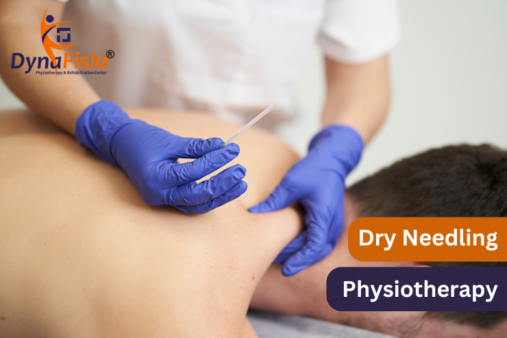 Pain Relief Beyond Pills: Harnessing the Power of Dry Needling in Physiotherapy