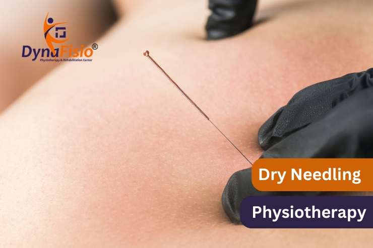 How Dry Needling Therapy Helps with Back Pain Management