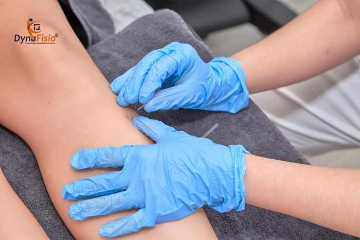 Why Athletes Trust Dry Needling for Calf Muscle Recovery