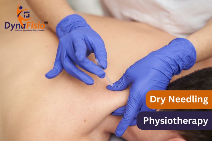 Enhancing Mobility: The Impact of Dry Needling Physiotherapy on Movement