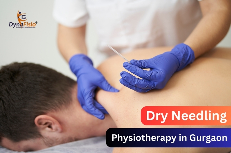 Dry Needling for Sports Injuries: The Secret to Enhanced Performance