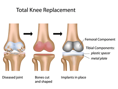 Postoperative knee replacement exercise