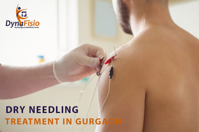 Everything You Need to Know About Dry Needling Treatment in Gurgaon