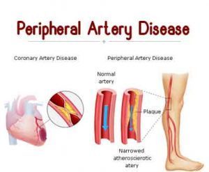Peripheral arterial disease
