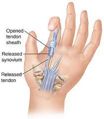 Trigger Finger- Treatment At Dynafisio