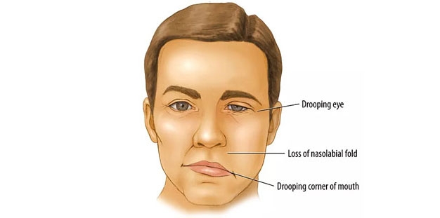 Bell's palsy physiotherapy