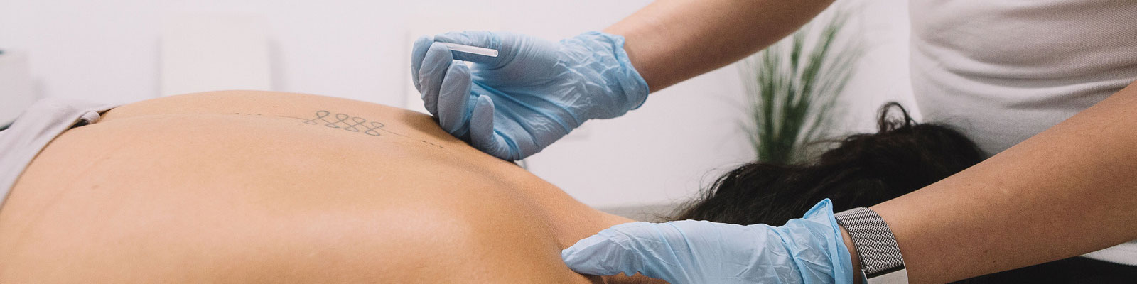  Dry Needling Therapy Treatment In Gurgaon