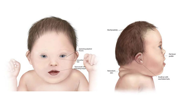Down Syndrome Physiotherapy Treatment in Gurgaon