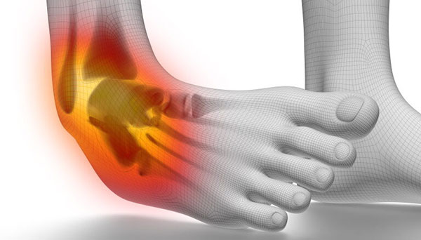 Ligament Strain, Sprain Physiotherapy Treatment in Gurgaon