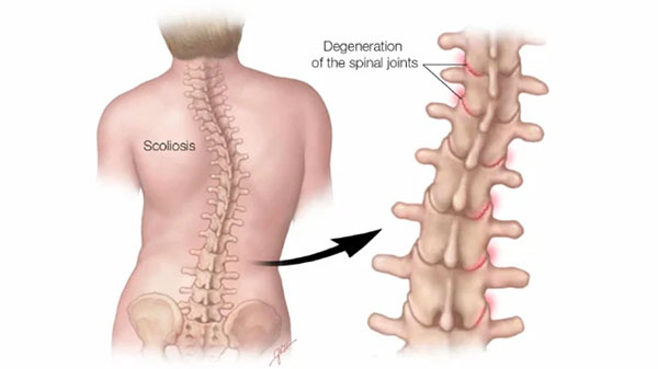 Scoliosis Physiotherapy Treatment in Gurgaon