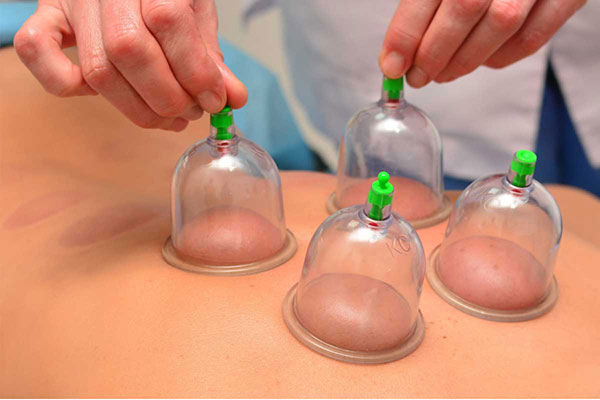 Cupping Therapy Treatment in Gurgaon